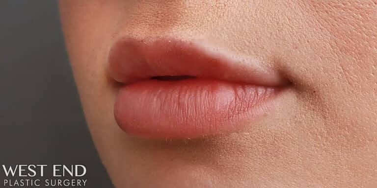 Restylane Before & After