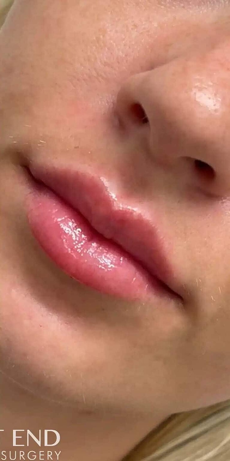 Restylane Before & After