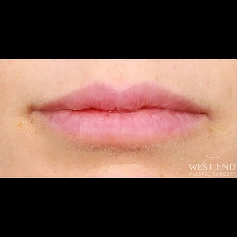 Restylane Before & After