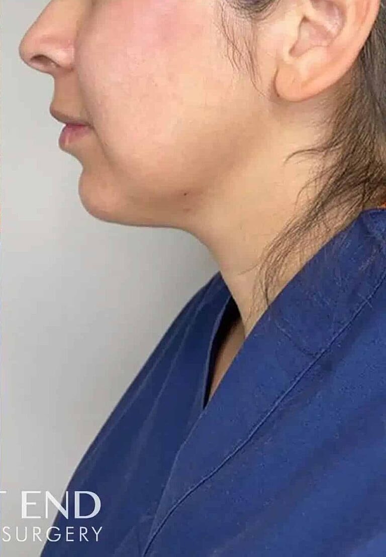 Restylane Before & After