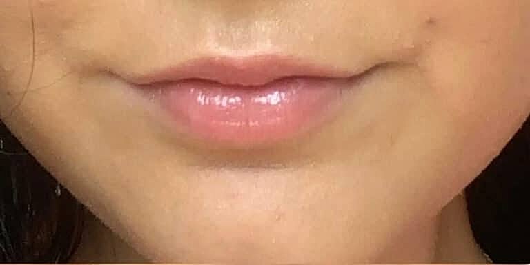 Restylane Before & After