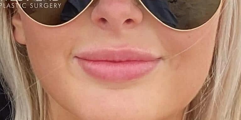 Restylane Before & After