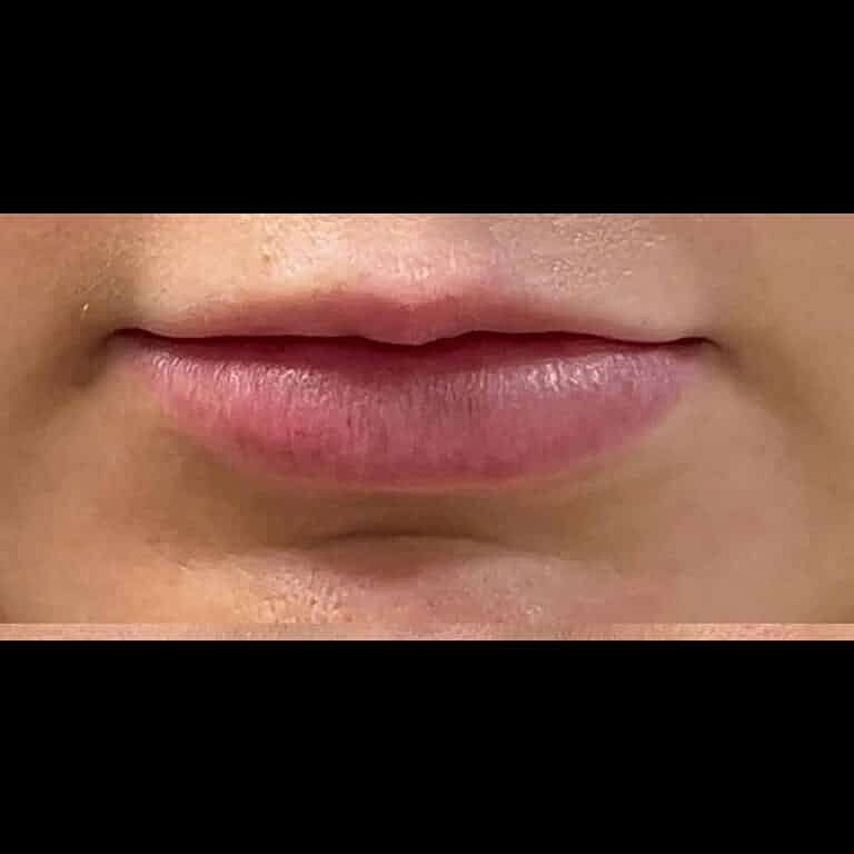 Restylane Before & After