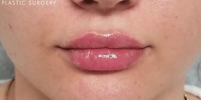 Restylane Before & After