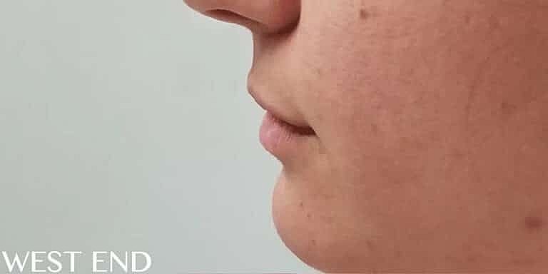 Restylane Before & After