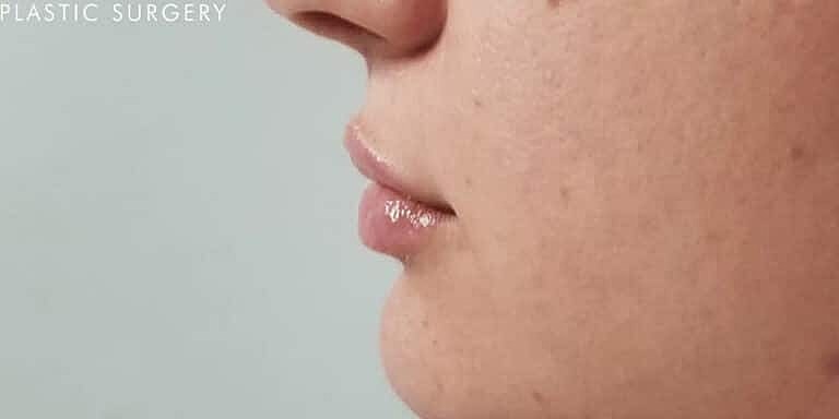 Restylane Before & After
