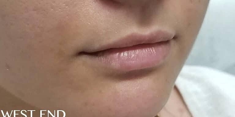 Restylane Before & After
