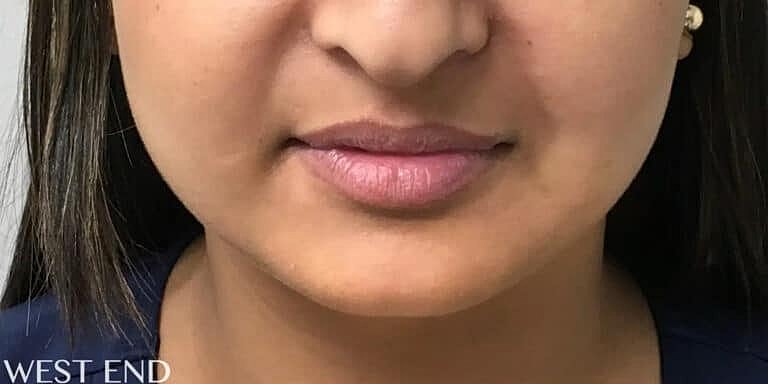 Restylane Before & After