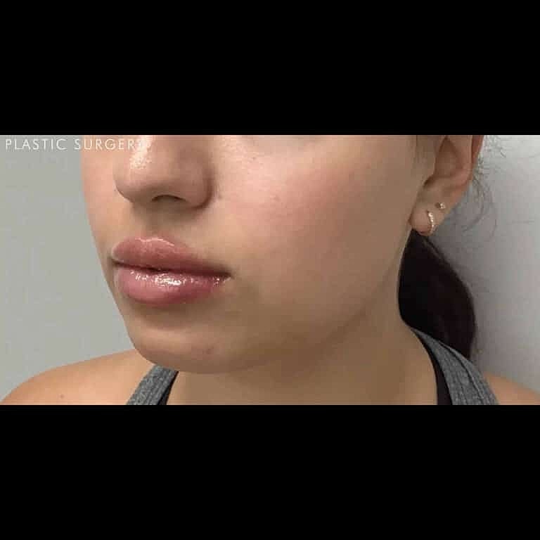 Restylane Before & After