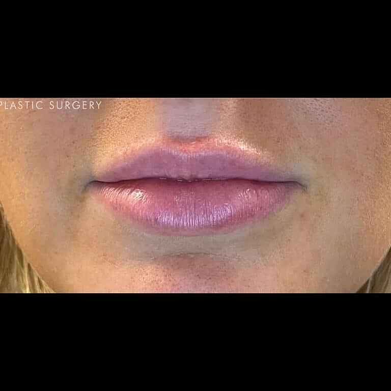 Restylane Before & After