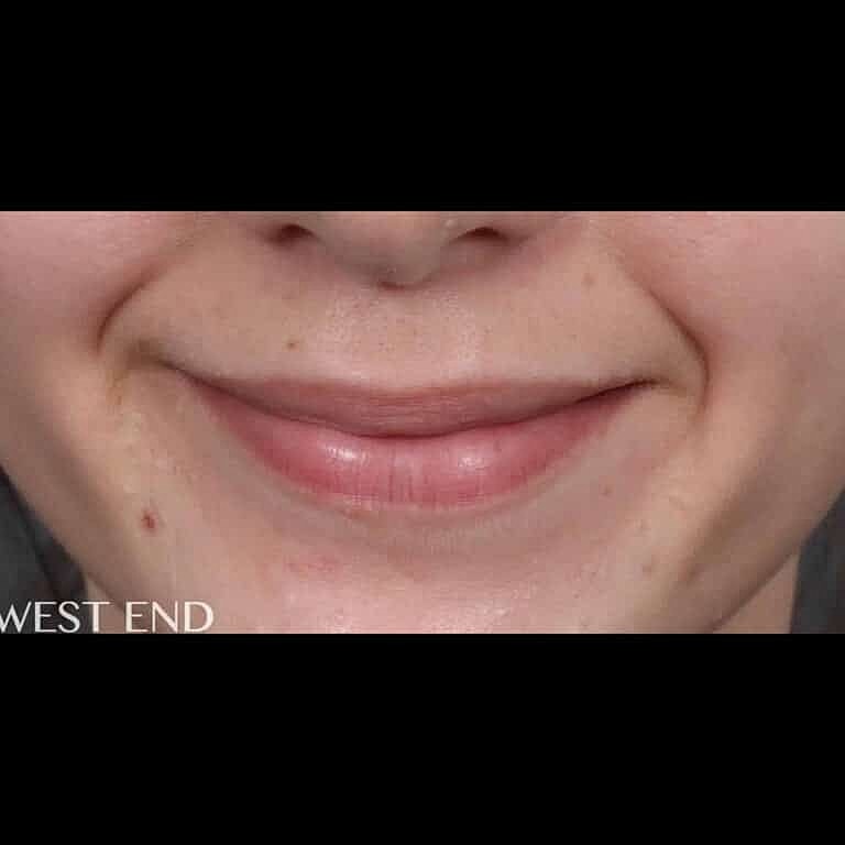 Restylane Before & After