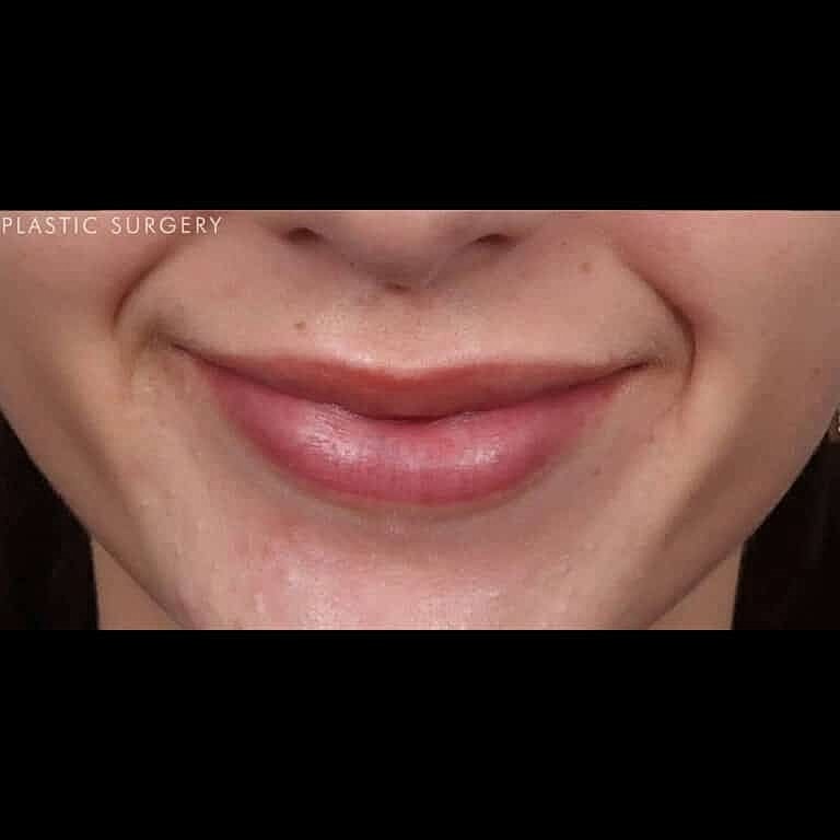 Restylane Before & After
