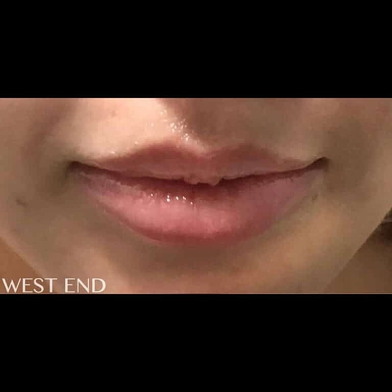 Restylane Before & After