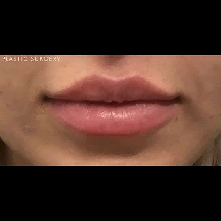 Restylane Before & After