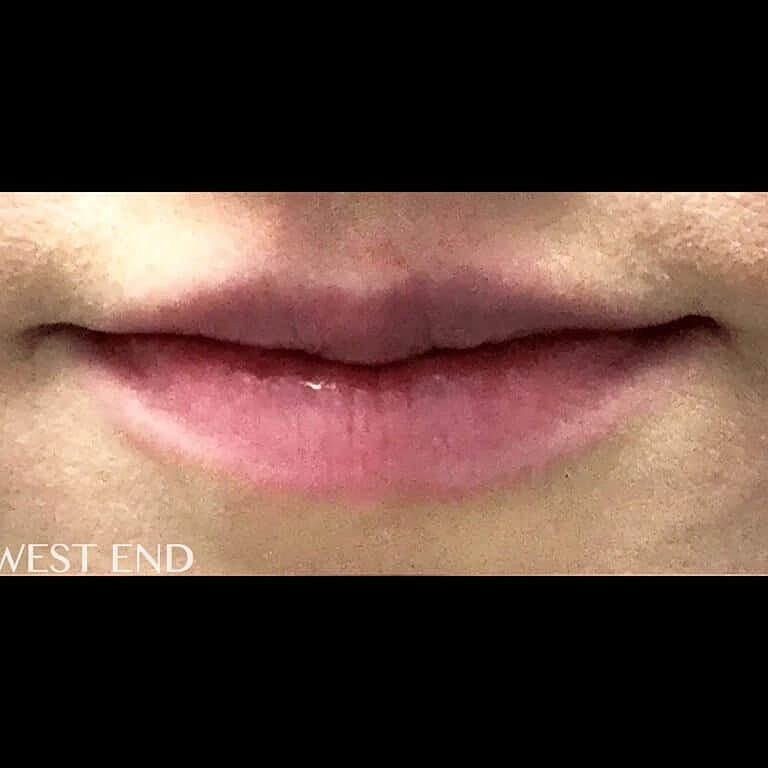 Restylane Before & After