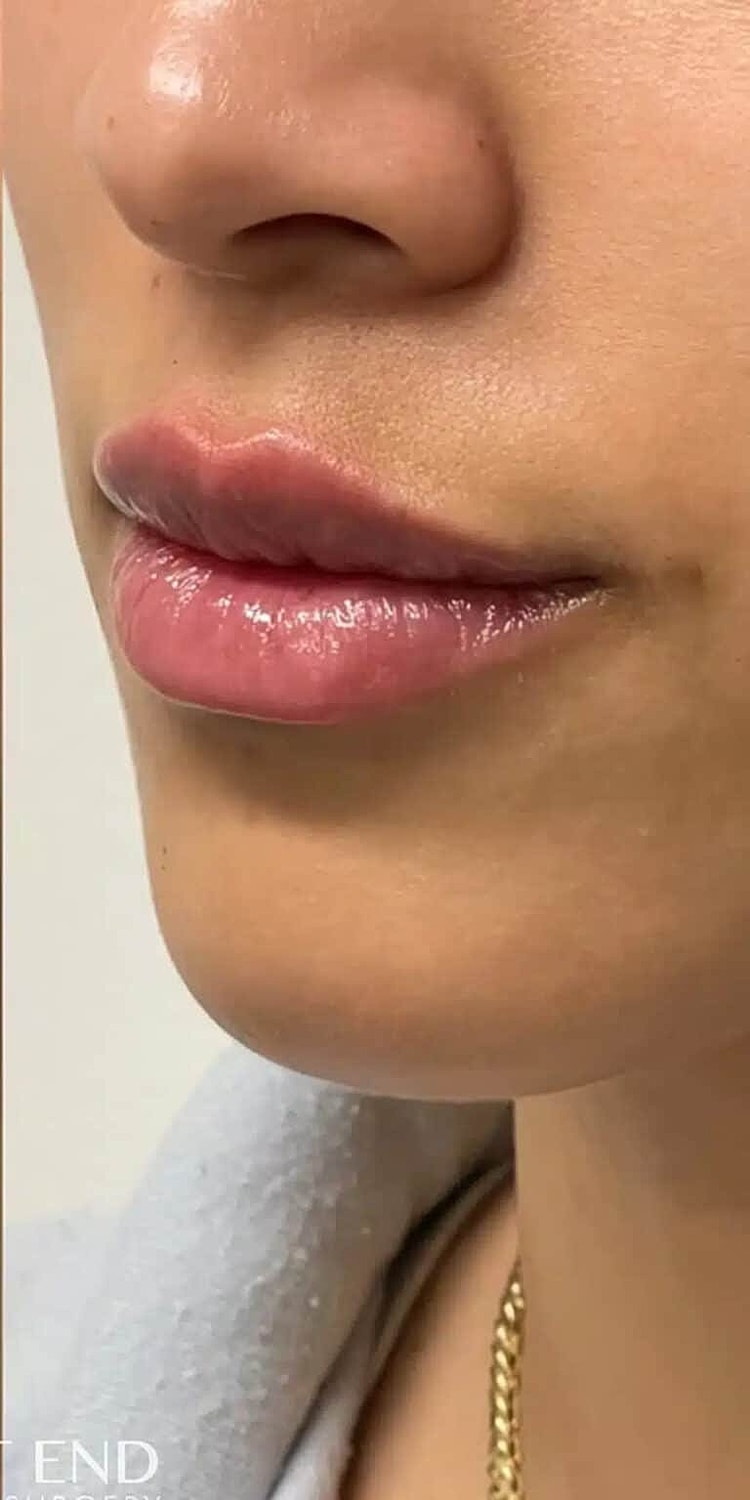 Restylane Before & After