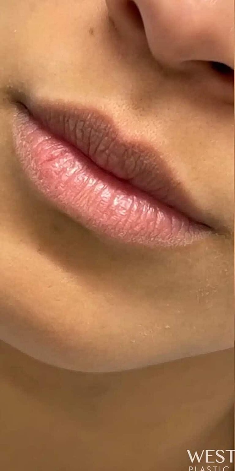Restylane Before & After