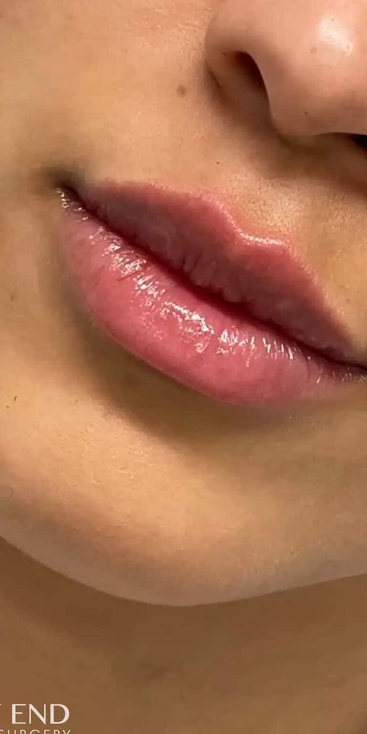 Restylane Before & After