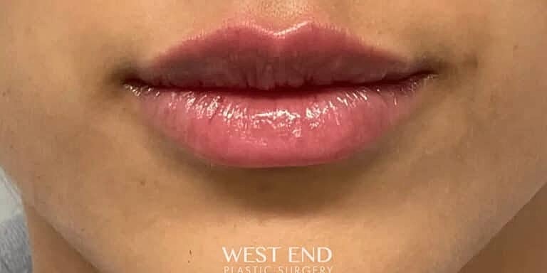 Restylane Before & After