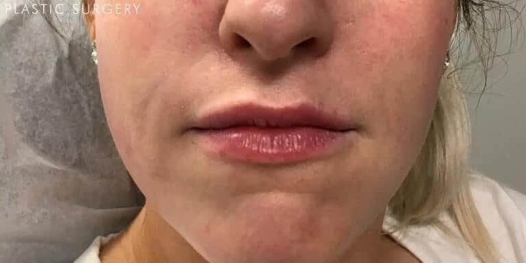 Restylane Before & After