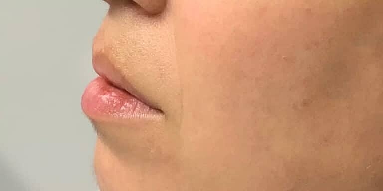 Restylane Before & After