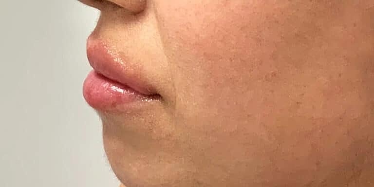 Restylane Before & After