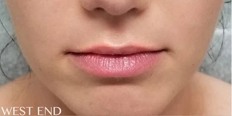Restylane Before & After