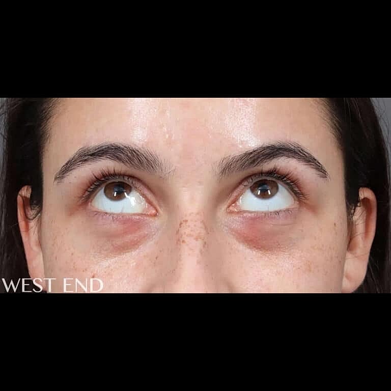 Restylane Before & After