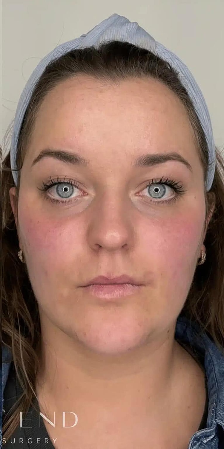 Restylane Before & After