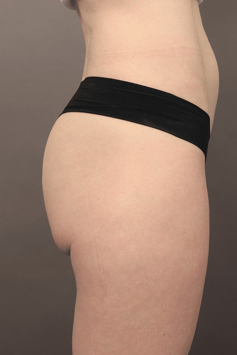 Sculptra Before & After