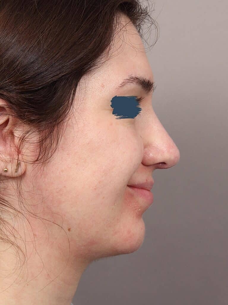 Nose Job Rhinoplasty Before & After