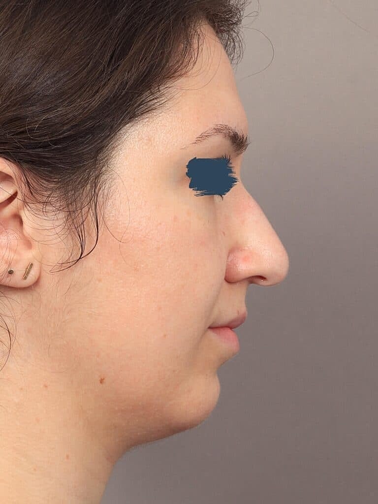 Nose Job Rhinoplasty Before & After