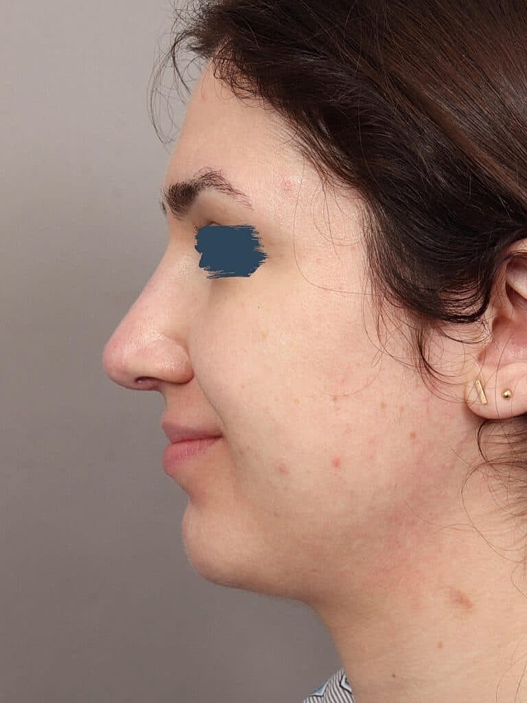 Nose Job Rhinoplasty Before & After