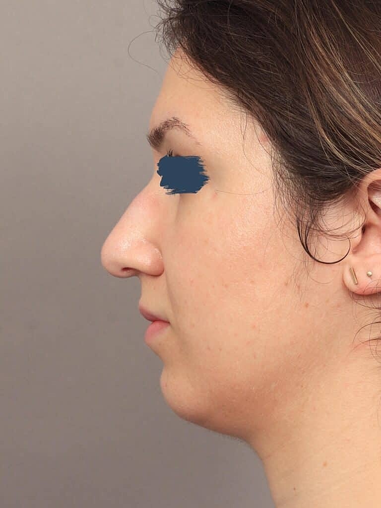 Nose Job Rhinoplasty Before & After