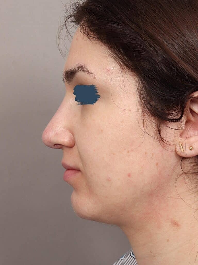 Nose Job Rhinoplasty Before & After
