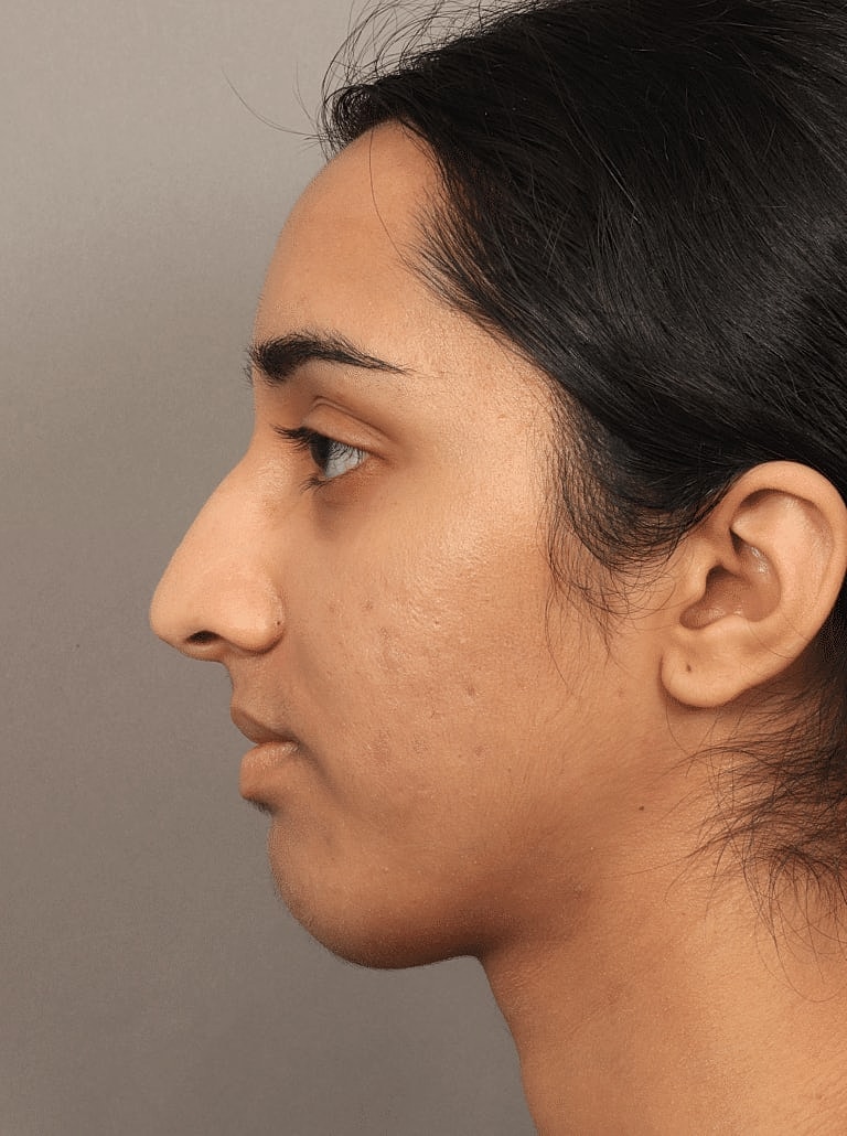 Nose Job Rhinoplasty Before & After
