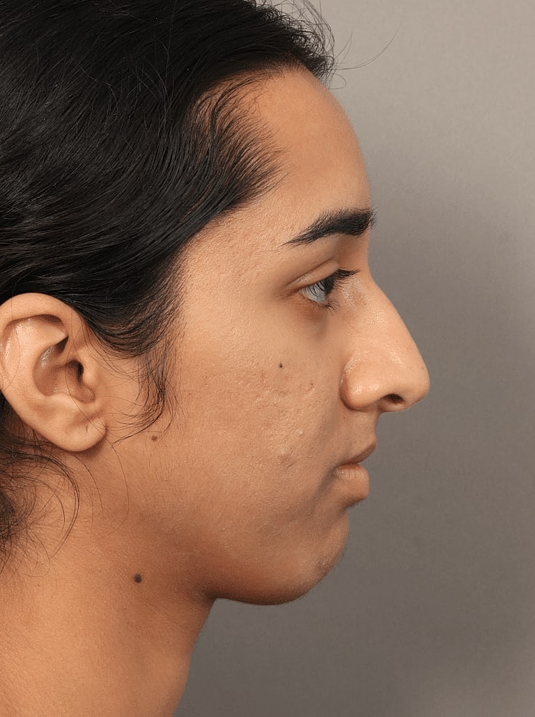 Nose Job Rhinoplasty Before & After