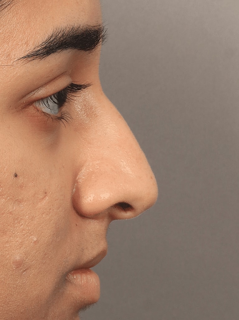 Nose Job Rhinoplasty Before & After
