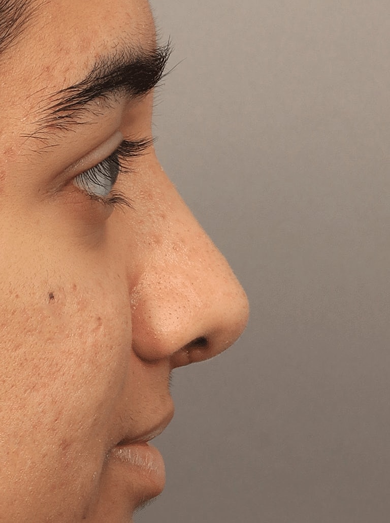 Nose Job Rhinoplasty Before & After