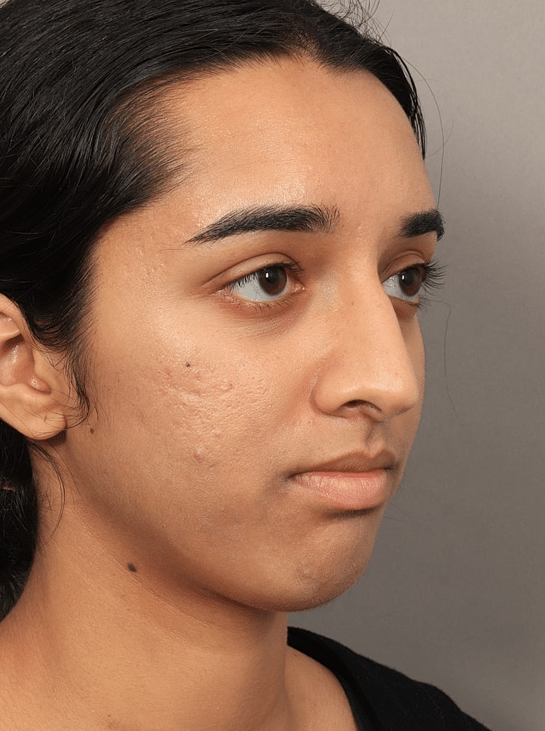 Nose Job Rhinoplasty Before & After