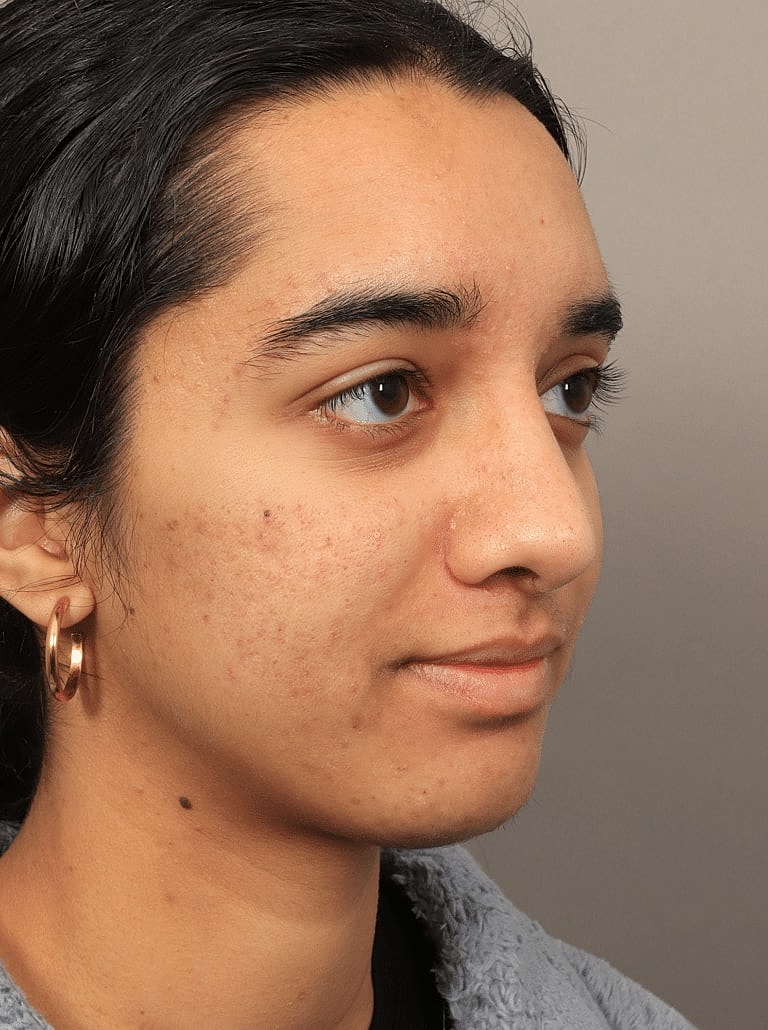 Nose Job Rhinoplasty Before & After