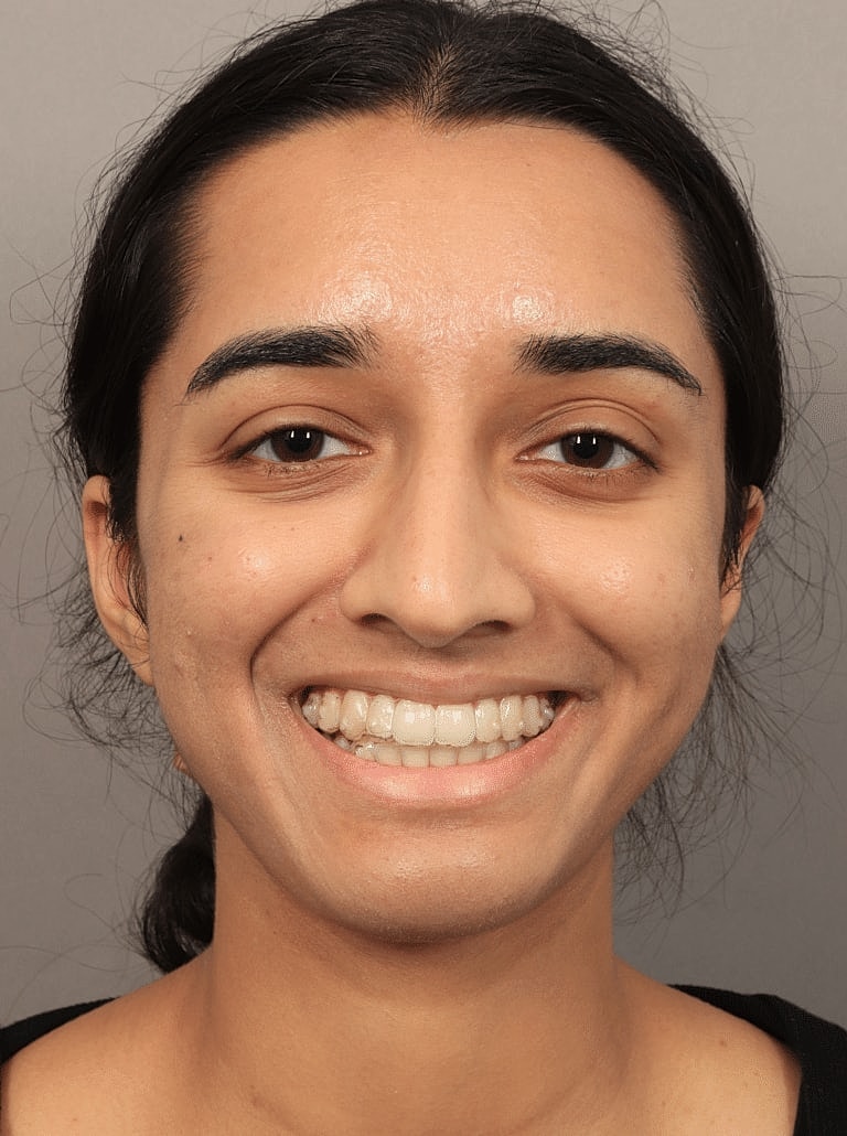 Nose Job Rhinoplasty Before & After