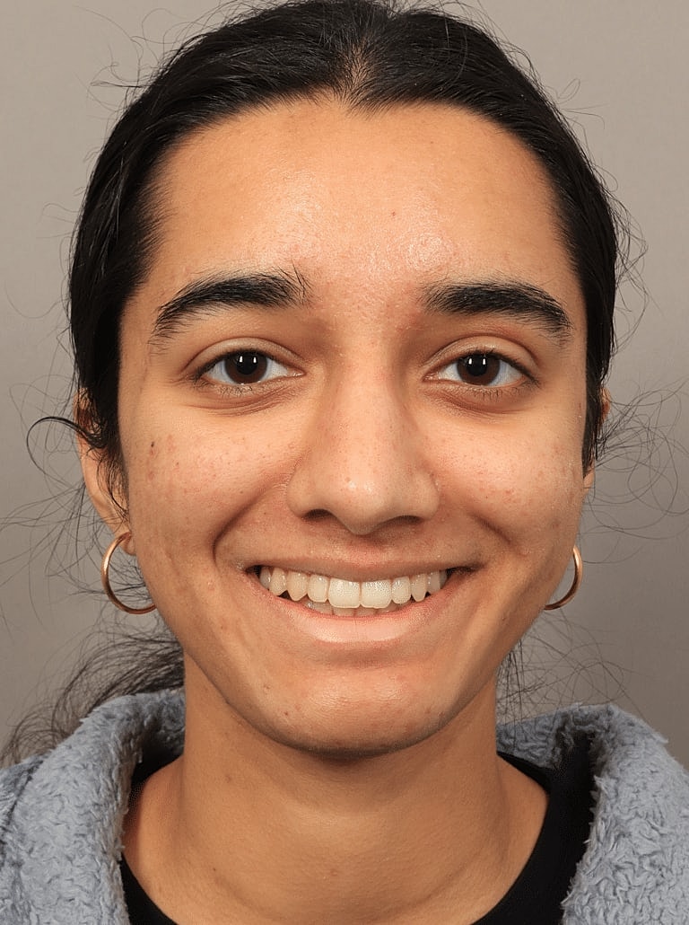 Nose Job Rhinoplasty Before & After
