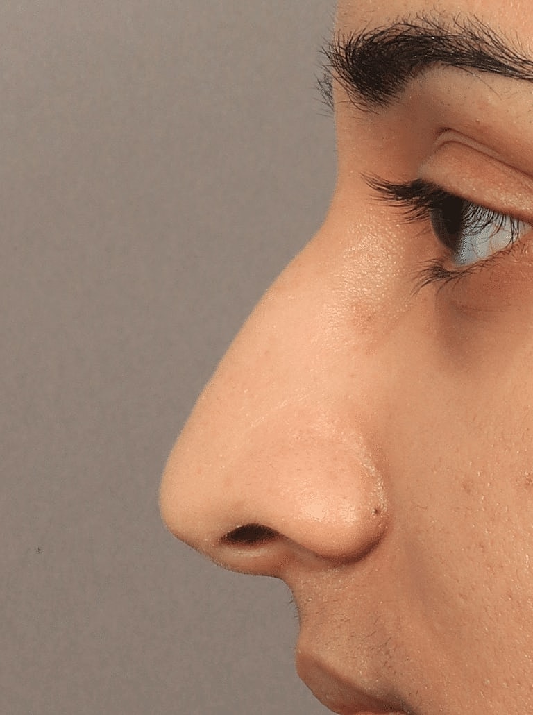 Nose Job Rhinoplasty Before & After