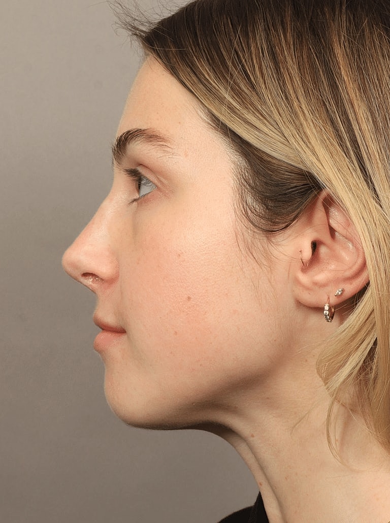 Nose Job Rhinoplasty Before & After