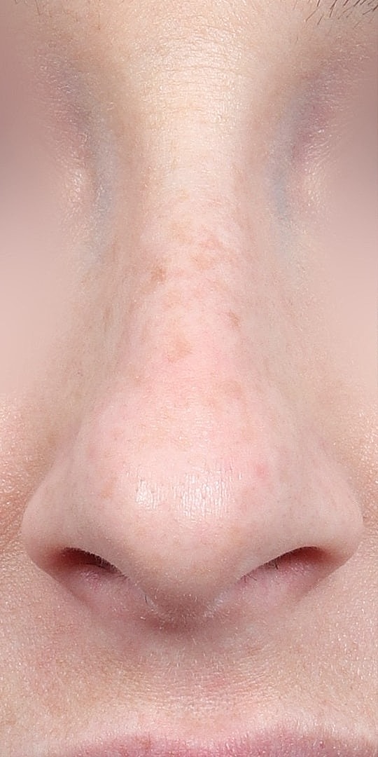 Nose Job Rhinoplasty Before & After