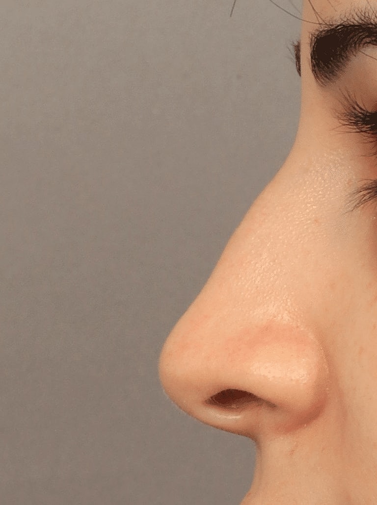 Nose Job Rhinoplasty Before & After