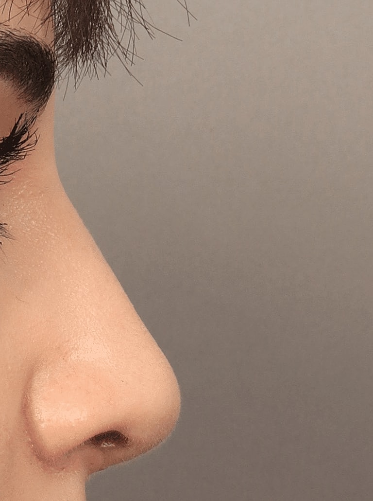 Nose Job Rhinoplasty Before & After