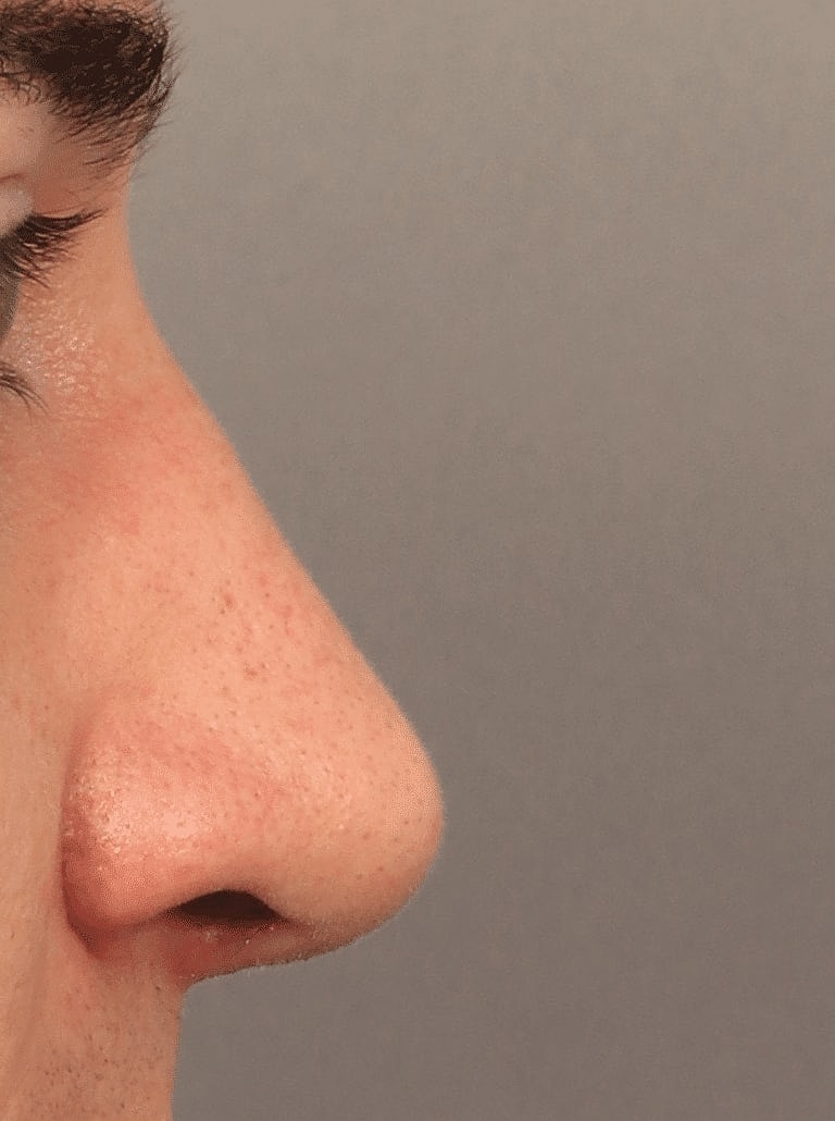 Nose Job Rhinoplasty Before & After
