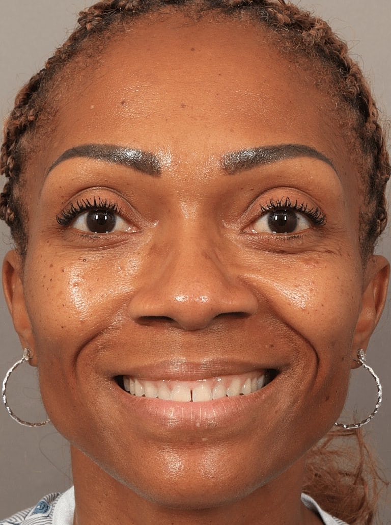 Nose Job Rhinoplasty Before & After